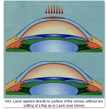 Lasik Eye Surgery Laser Vision Correction